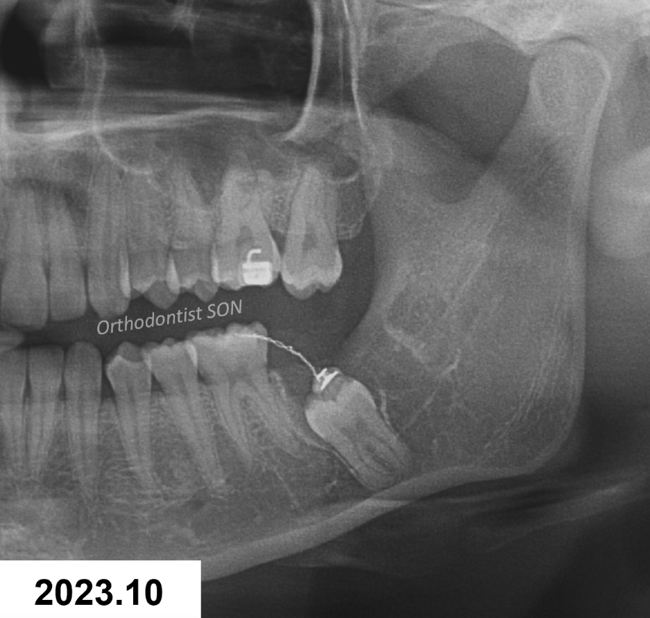 2023.10 아래 왼쪽 제2대구치 방사선사진