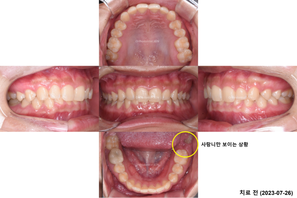 치료 전 구강 내 사진