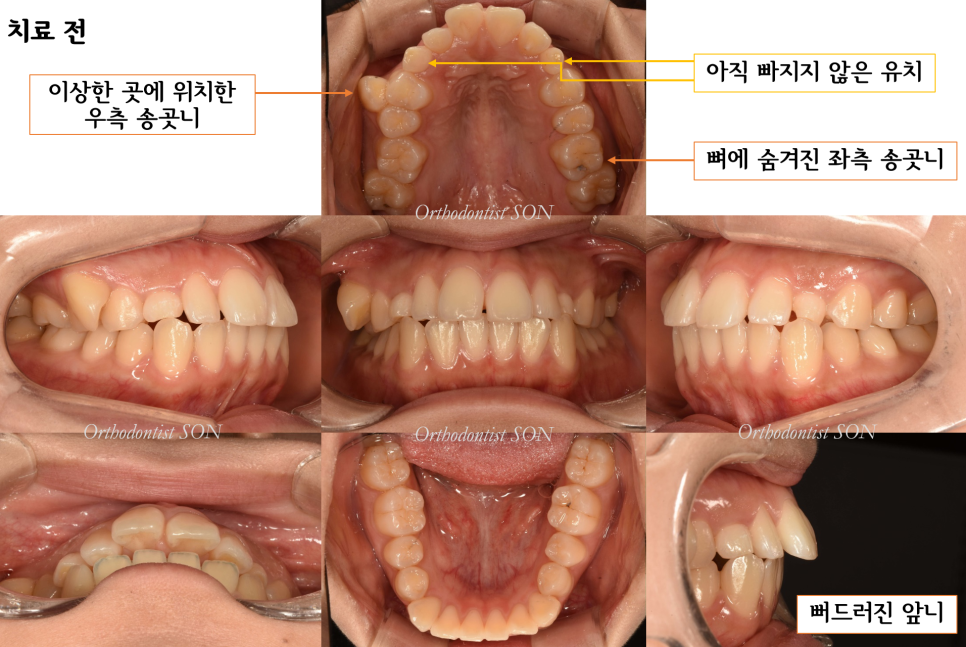 치료 전 구강 내 사진