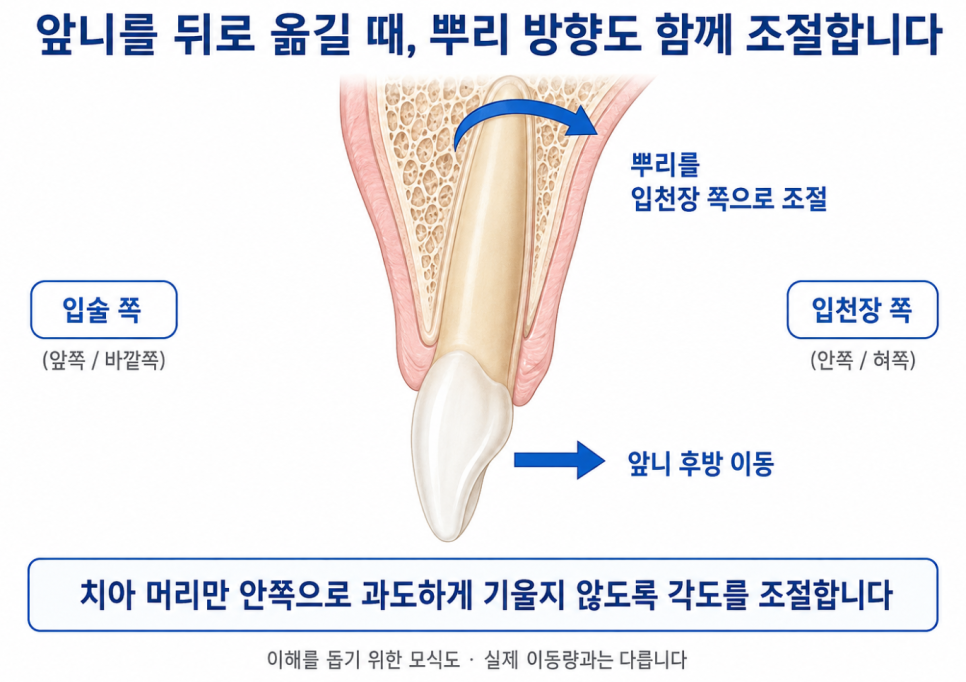 앞니 이동 시 치아 머리와 뿌리의 각도 조절을 설명하는 그림