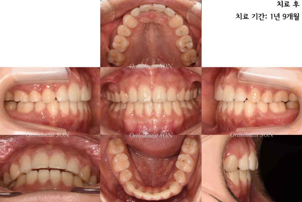 치료 후 구강 내 사진