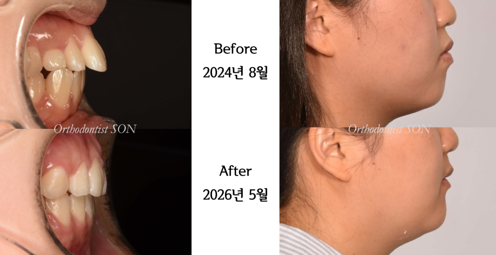 치료 전후 입술 윤곽 비교
