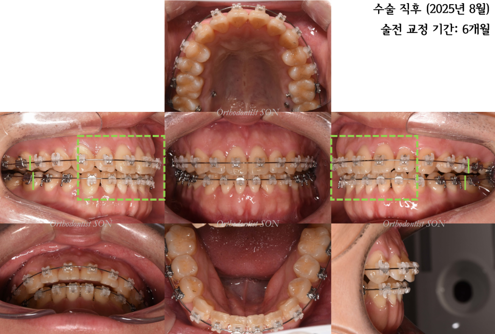 수술 후 1개월 · 술후 교정 과정