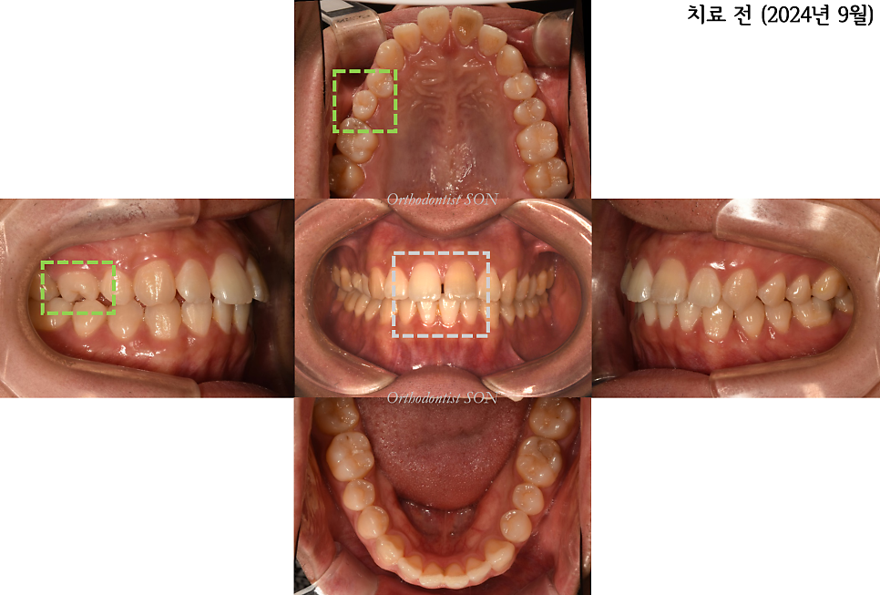 치료 전: 앞니 공간과 정중선 불일치, 오른쪽 위 작은어금니의 회전