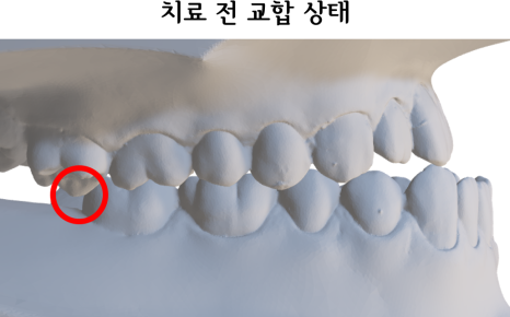 치료 전 교합 상태 · 위쪽 뒤 어금니의 위치