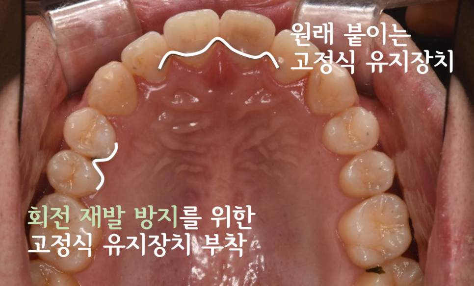 앞니 유지장치와 작은어금니 부위에 추가한 고정식 유지장치