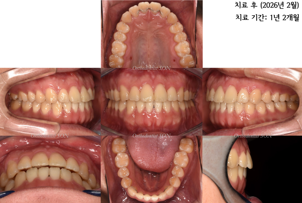 치료 후 · 앞니와 어금니 맞물림