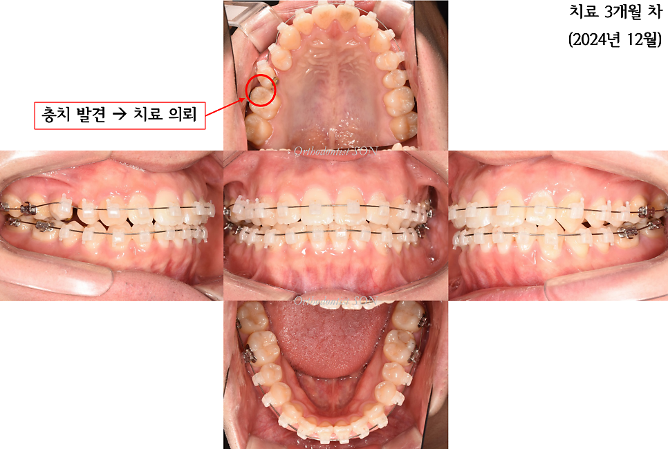 치료 3개월째: 앞니 공간 폐쇄와 작은어금니 회전 개선 과정