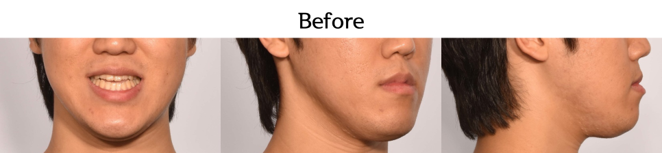 치료 전 · 얼굴 정면과 측면