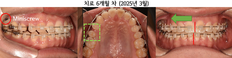 치료 6개월째: 회전 개선 후 미니스크류를 이용한 정중선 조절
