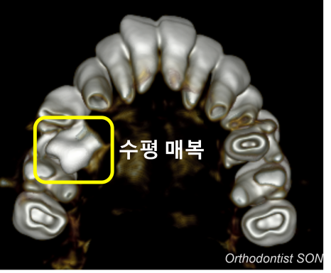 치료 전 CT · 매복치와 인접 치아 관계