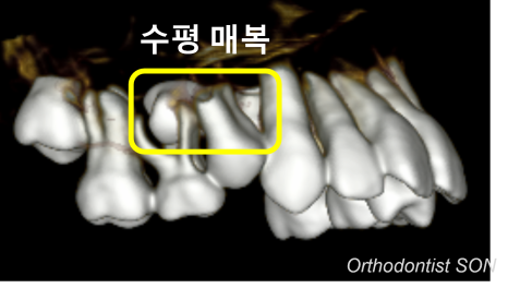 치료 전 CT · 수평 매복 위치