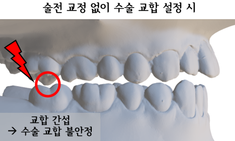 술전 교정 없이 수술 교합을 설정할 때의 간섭