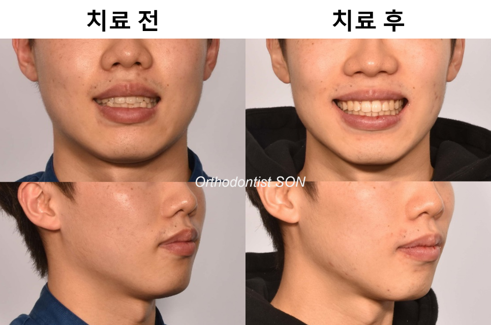 치료 전후 · 정면과 측면의 변화