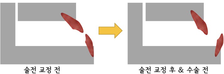 술전 교정 전후 치아 각도 변화 다이어그램