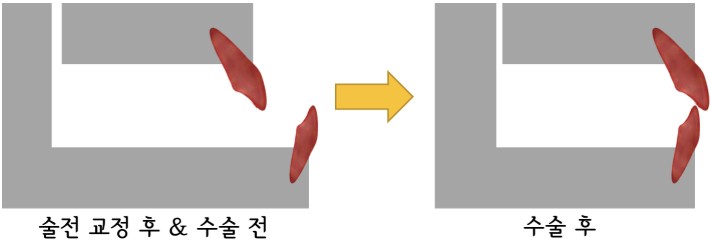 악교정 수술 전후 턱뼈 위치 변화 다이어그램