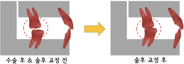 술후 교정 전후 어금니 교합 변화 다이어그램