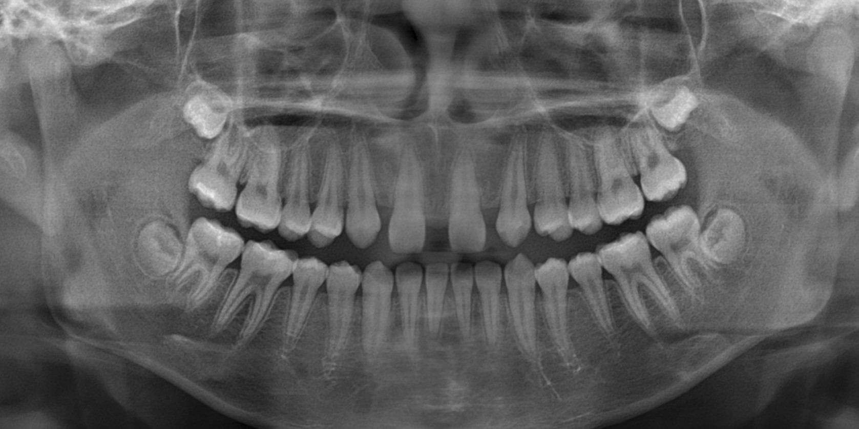 측절치 선천성 결손이 보이는 파노라마 X-ray