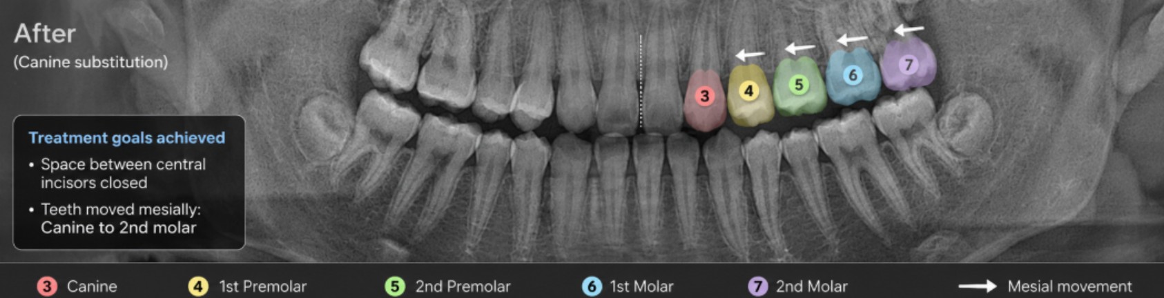 송곳니 대치 후 치아 이동 결과를 보여주는 X-ray