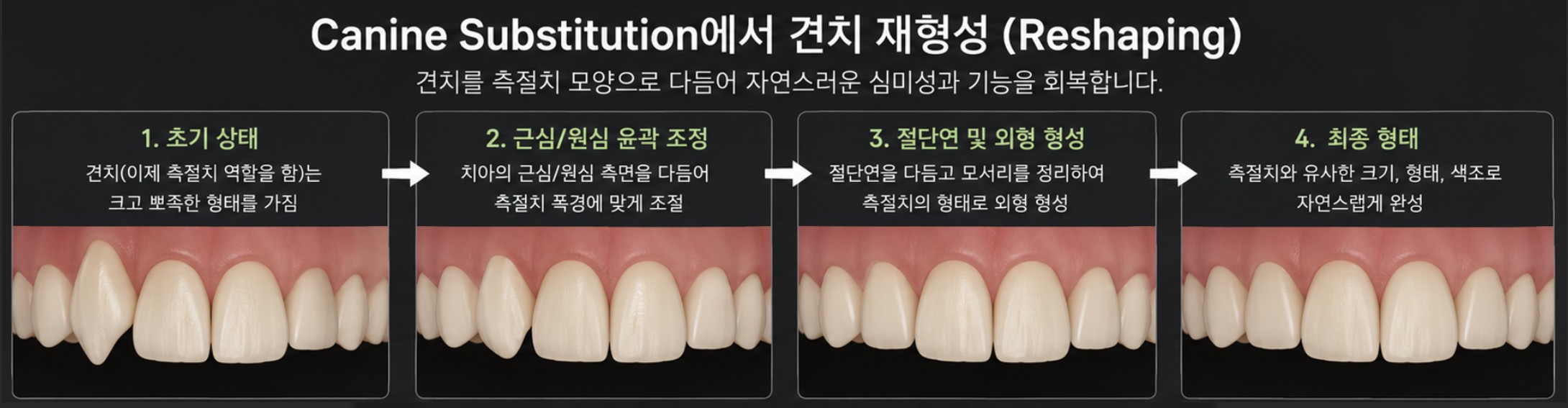 견치 재형성(Reshaping) 4단계 과정