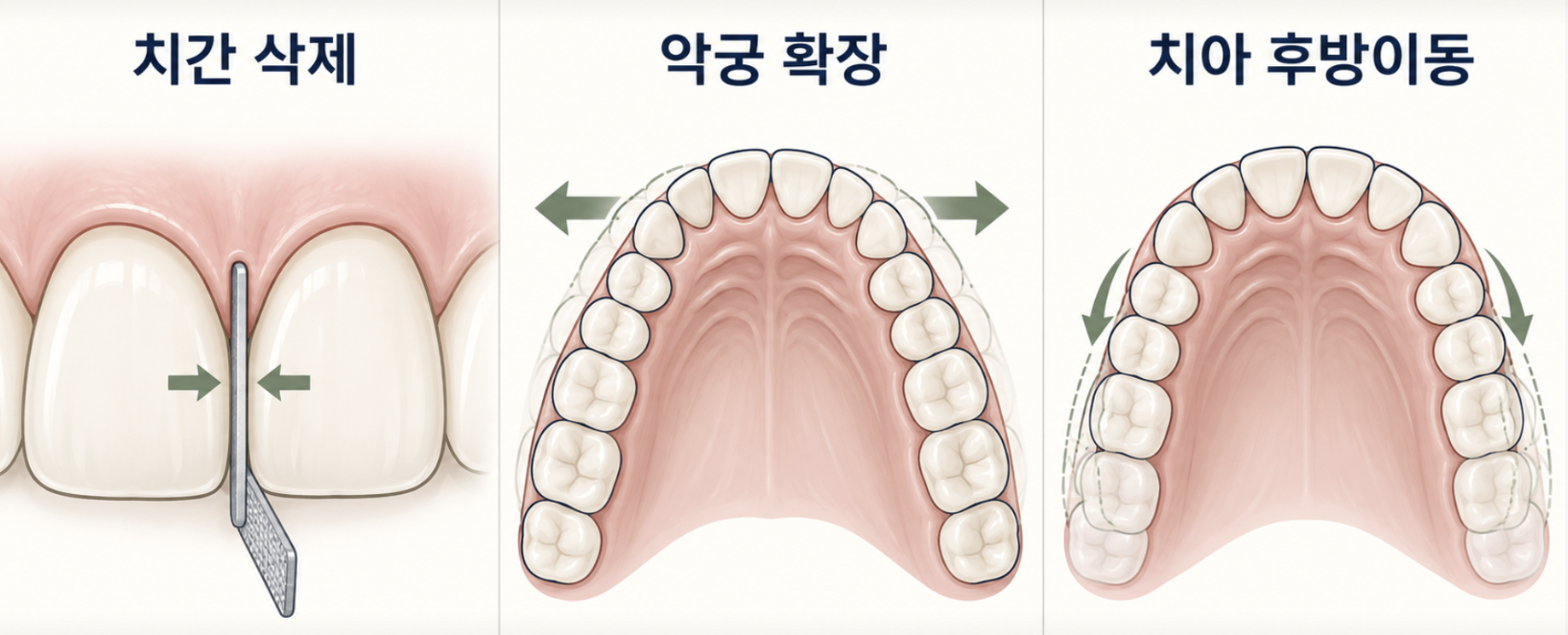 비발치 공간 확보 방법: 치간삭제, 악궁 확장, 치아 후방이동